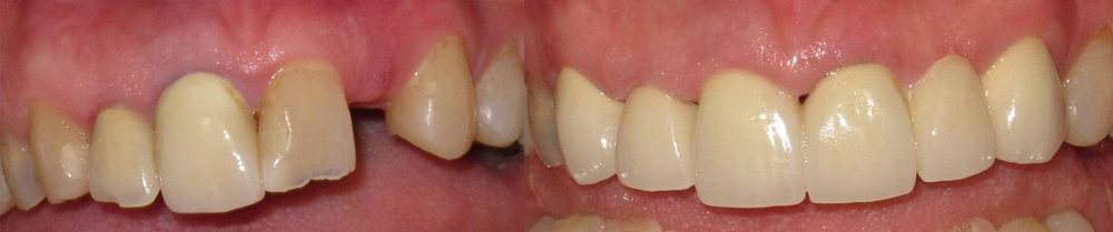 Dental Bridges