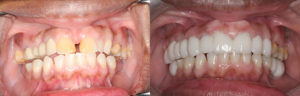 3-intra-oral-before-and-after