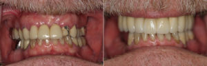 6-intra-oral-before-and-after