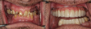 7-intra-oral-before-and-after