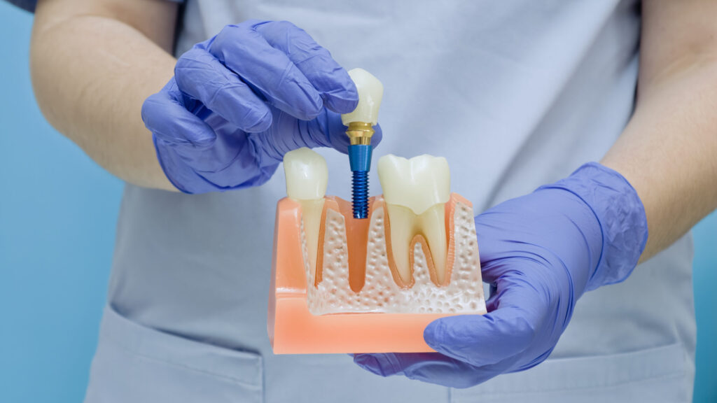 Dentist holding an anatomical model with a dental implant