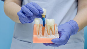 Dentist holding an anatomical model with a dental implant